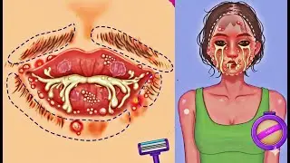 I treated a girl's Mouth and Face that was oozing pus.Most Satisfying ASMR Makeover l Spa Roleplay