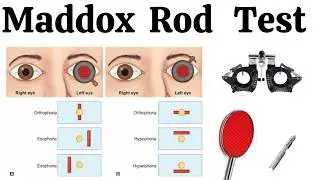 Maddox Rod Test #maddoxrodtest #maddoxrod  #heterophoria #phoria #strabismus #optocruisers #squint