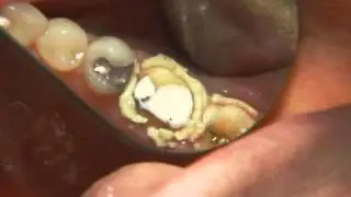 Traxodent Retraction Cap