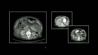 &ldquo;Instant Diagnosis&rdquo; Emergency Neoplasm Presentations 2 | 15 Minute Radiology CME