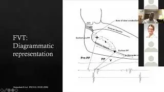 9 24  20 Tholakanahalli Fasicular PVC:VT Ablation