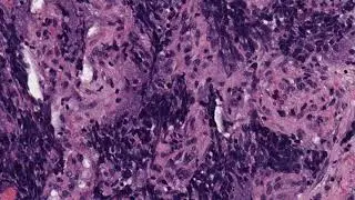 Merkel Cell Carcinoma