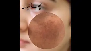 Freckles removal potato face gel