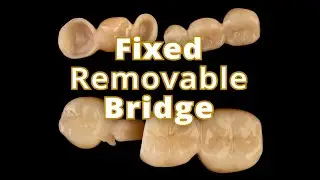 Fixed Prosthodontics &ndash; Dental Bridges