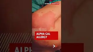Alpha Gal Allergy Explained #foodallergy #foodallergyawareness