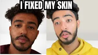 I FINALLY IMPROVED MY SKIN