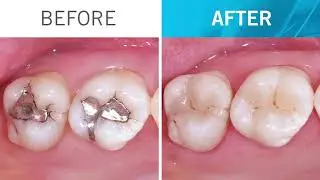 Step by step ONE Shade restoration with Venus Pearl ONE by Dr. Veneziani (EN)