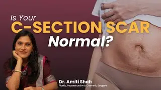 Your C-Section Scar Doesn't Have to Be Permanent (Surgical Options Explained)