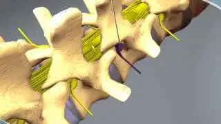 What to expect during a Nerve Root Block at CDI