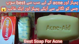 Acne Aid Bar Soap Honest Review | Which is the best soap for acne | Acne ke Liye best soap |Acne-Aid