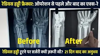 रेडियस हड्डी फ्रैक्चर बिना ऑपरेशन क्या खतरा था पहले-बाद का X-ray और 21 दिन बाद |Radius Bone Fracture