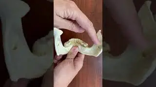 Онемение нижнего альвеолярного нерва