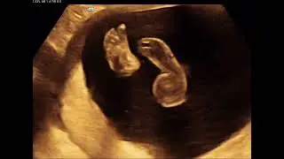 Bilateral club foot fetal ultrasound