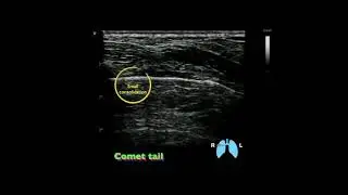 〖Ultrasound〗Comet tail artefact (this is not B-lines) & a small consolidation in LUS (long COVID)