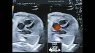 Fetal anomaly detailed scan
