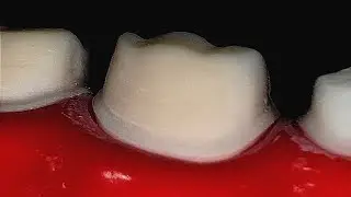 crown preparation/Ideal toothpreparation@Drharishankarsoni @5minDENTISTRY