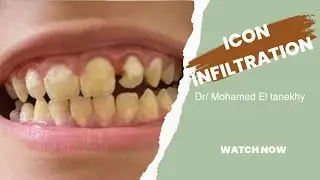 Treatment of white lesion or enamel hypoplasia  by icon infiltration علاج البقع البيضاء للأسنان