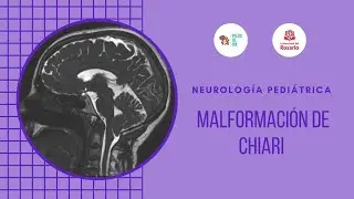 Malformación de Chiari - PEDS IG UR, Módulo de neurología pediátrica