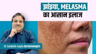 झांइया, Melasma का आसान इलाज। Skin Specialist Dr द्वारा।
