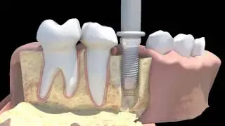 Z Look3 Implant System - All Ceramic Implants