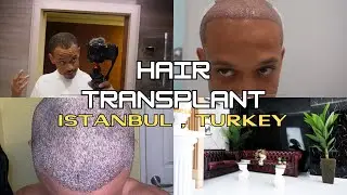 Afro American FUE Hair Transplant