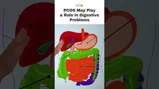 PCOS May Play a Role in Digestive Problems