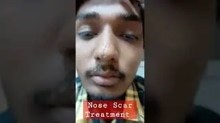 Nose Scar Removal Treatment #scartreatment #skincare