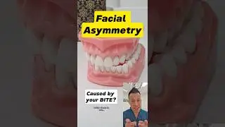 Facial Asymmetry Explained: Impact of Functional Shifts! #dentallan #dentist #shorts