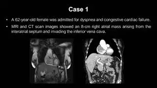 EUS-FNA of 2 right atrial masses