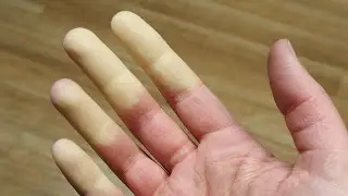 What is Raynaud's disease?