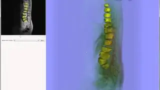 Robust Detection and Segmentation for Diagnosis of Vertebral Diseases using Routine MR Images