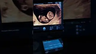 3- homiladorlikdan 1- tugʻruq #medical #dopler #baby #pregnancyjourney #shortsvideo