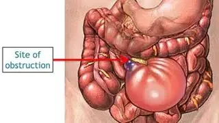 Intestinal obstruction by Dr.Suror Ibrahim 