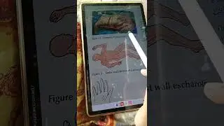 Ch 13 pt 2 ,burn injuries, general surgery dogar