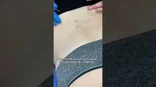 What are the benefits of dry needling?
