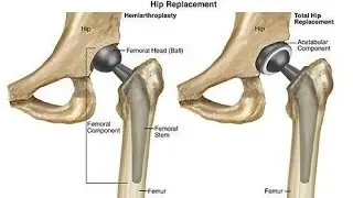 hip arthroplasty or hip replacement surgery; damaged hip joint replaced with artificial implant
