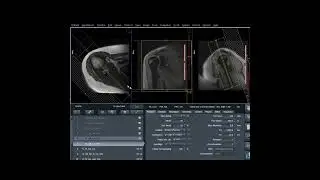 MRI  Shoulder Case Explained | Learn From Imaging