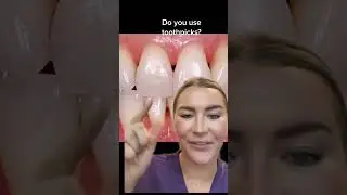 dont use toothpicks!!!! #toothpick #floss #blacktriangle #recedinggums #fyp #teeth