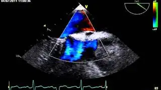 OSTIUM PRIMUM ATRIAL SEPTAL DEFECT / ECHOCARDIOGRAPHY cardiac ultrasound