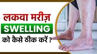 लकवा मरीज़ सूजन को कैसे ठीक करें? | Paralysis Patient Swelling Recovery | Dr Puru Dhawan