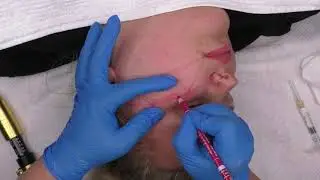 Hyaluron Pen Advance