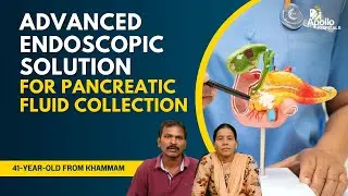 Pancreatitis Treated Without Surgery | Minimally Invasive Endoscopic Drainage | Dr. Jatin Yegurla