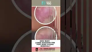 How Many Laser Sessions do we Need for Port- Wine Stain Removal? Laser treatment of Port-Wine Stains