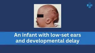 An infant with low set ears and developmental delay