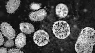 U.S. declares monkeypox a health emergency
