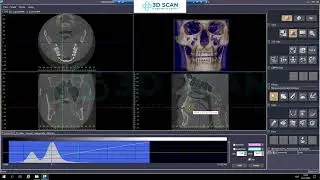 Чем 3D диагностика в i-Dixel отличается от 2D панорамы? Разбор для врачей |Morita| |OneVolumeViewer|