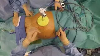 Docking Tips for Robot assisted prostatectomy with the X system
