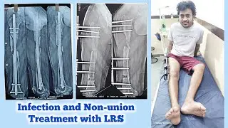 Femur bone fracture Infection and non-union मध्यप्रदेश से आया मरीज  #ilizarovsurgery