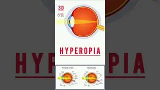 Hyperopia #shorts