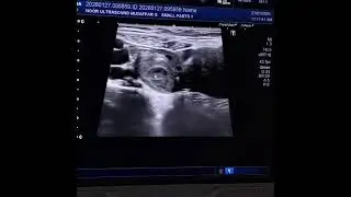 Hemmorhagic Corpus Luteum
